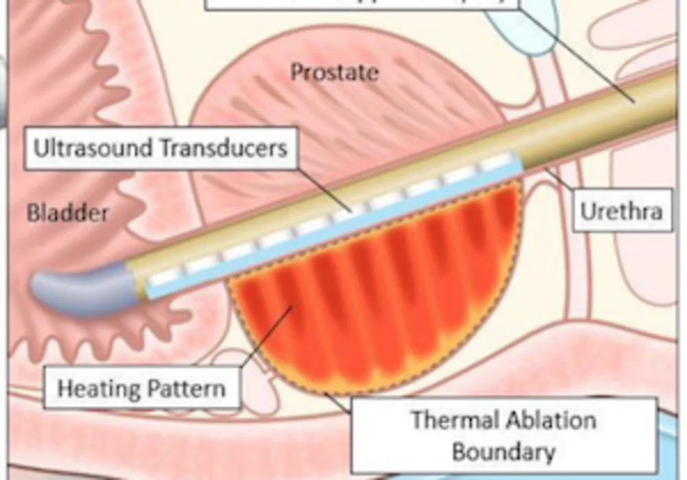 RSNA 2019: Novel MRI-Guided Ultrasound Treatment Destroys Prostate Cancer