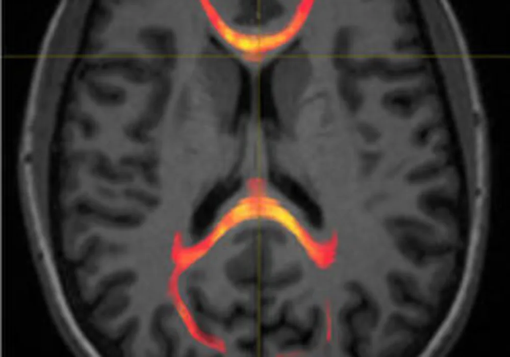 MRI Concussion