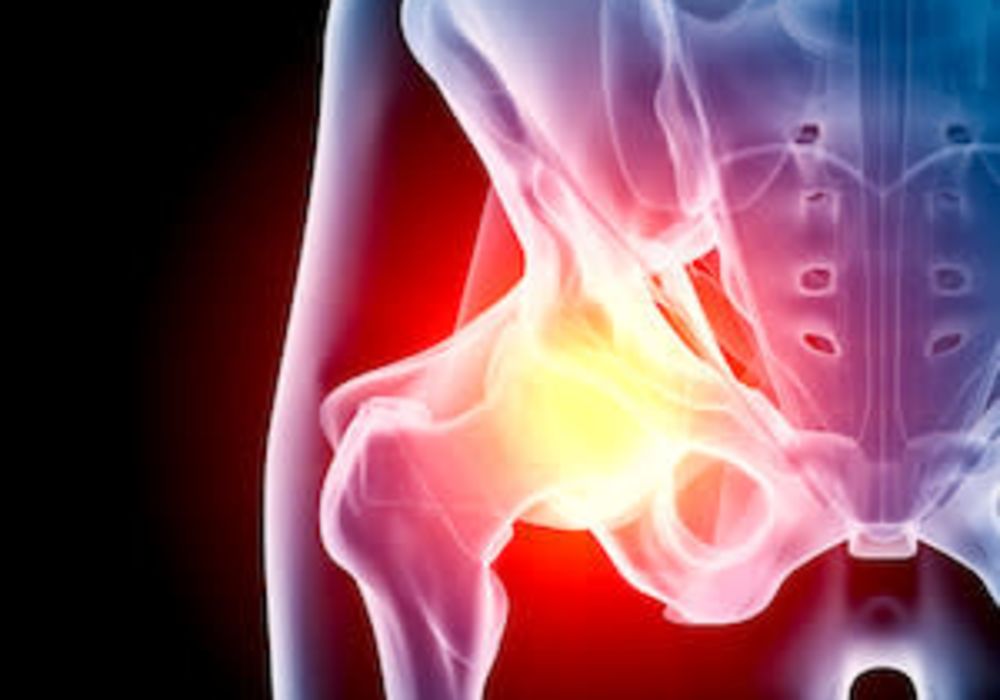 Hip arthritis