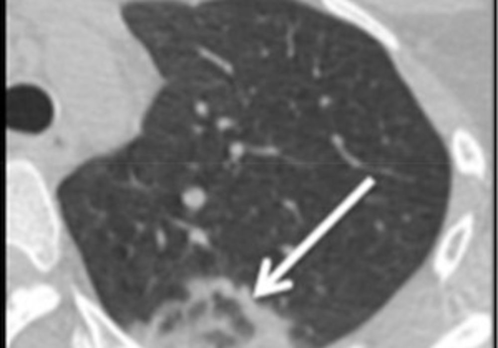 Axial CT Scan of Lung