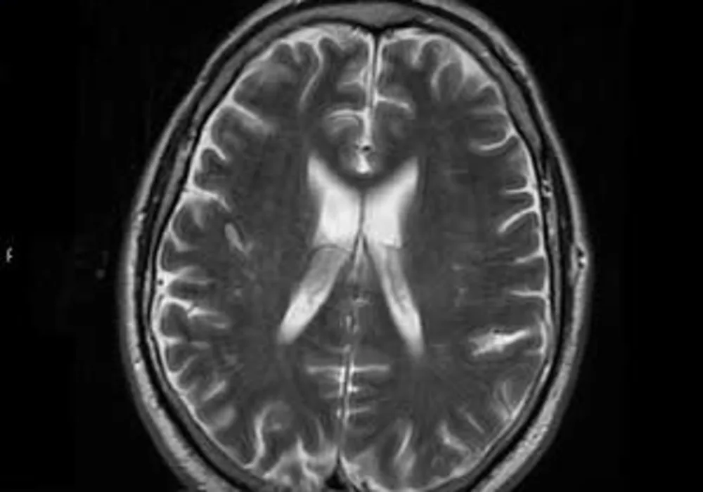 Stereotactic Radiotherapy for Small Cell Lung Cancer Brain Metastases 