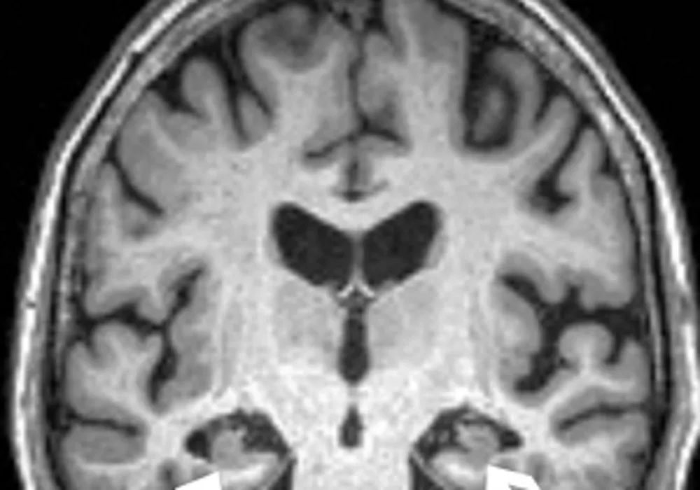 #RSNA20: Anxiety Associated with Faster Onset of Alzheimer&#039;s Disease