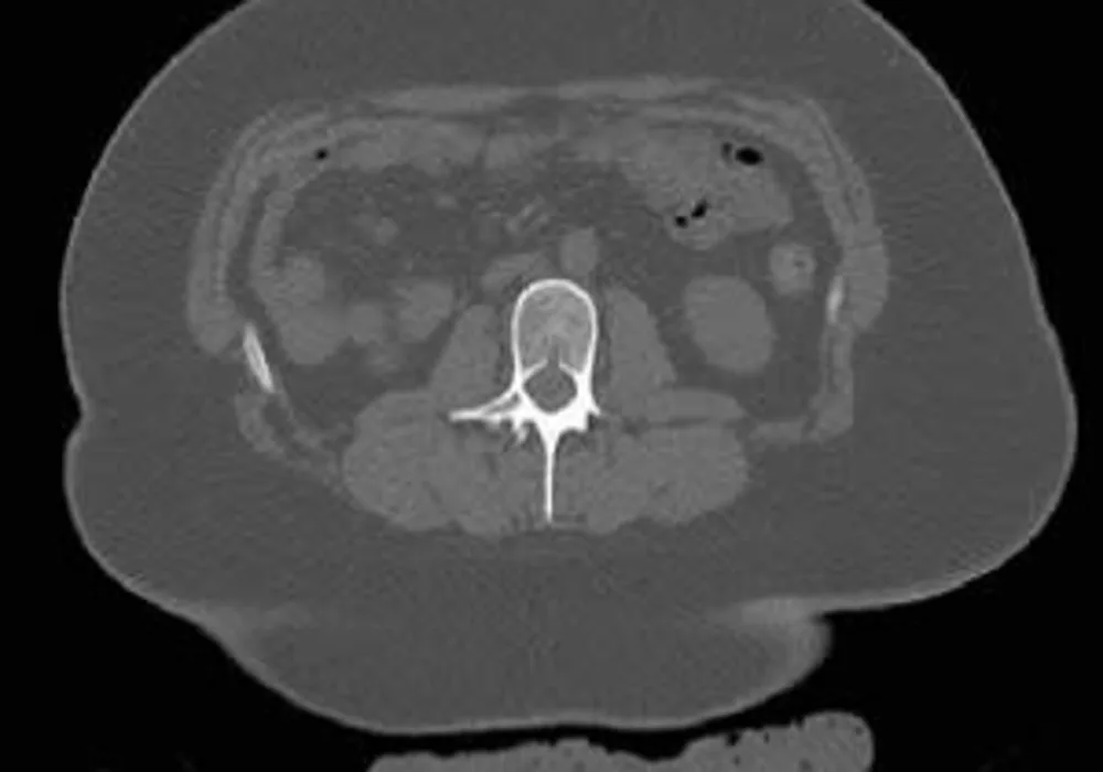 #RSNA20: Sleeve Gastrectomy in Teenagers Weakens Bones