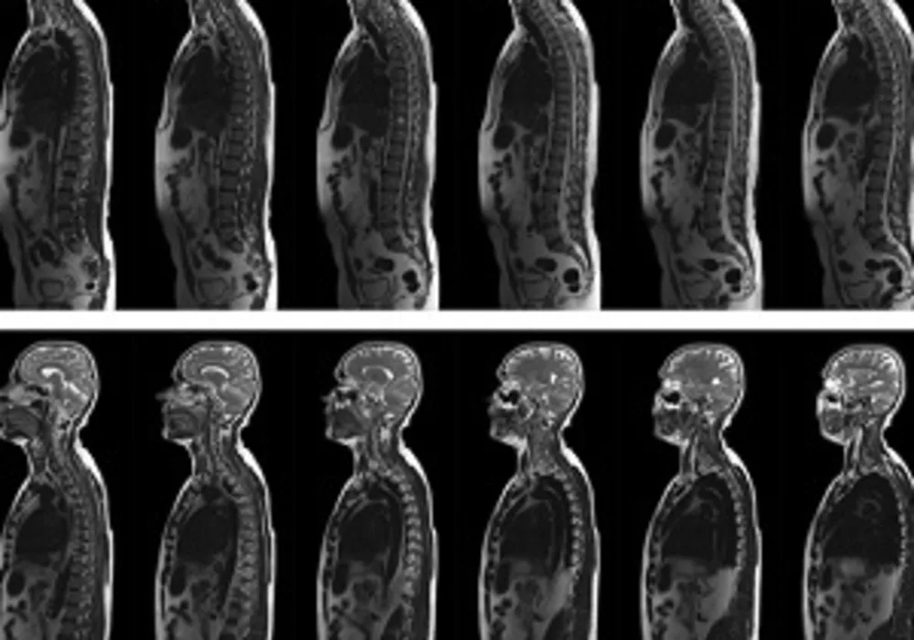 Deep Learning with Whole-body MRI Recognises Diabetes