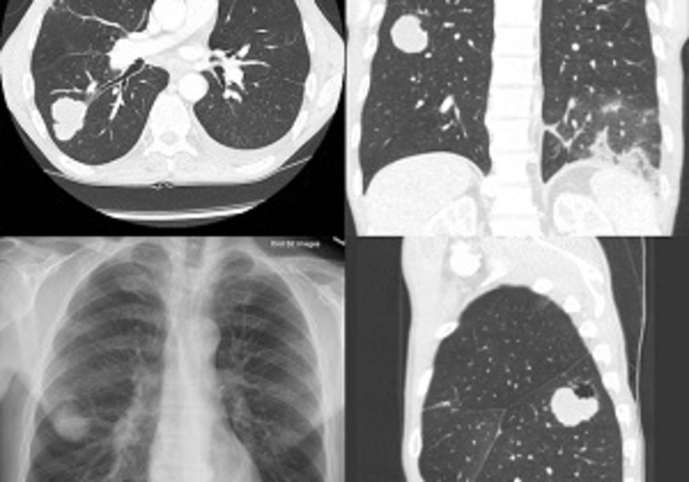 Cancer Screening Drops after Diagnostic CT