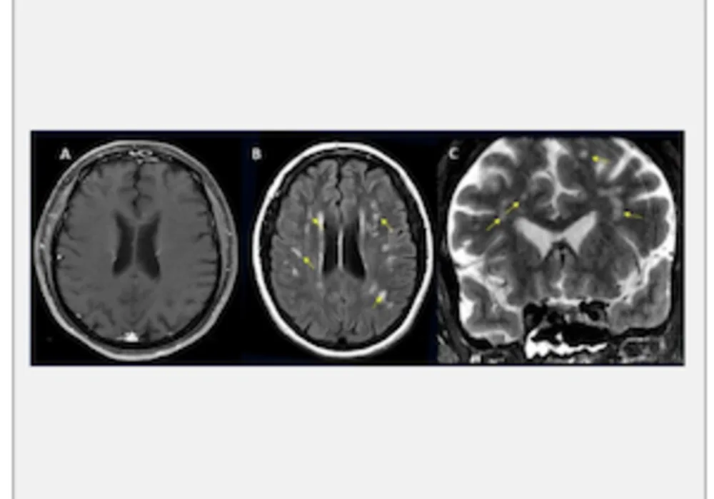 #RSNA21: Spectrum of COVID-19 Brain Complications