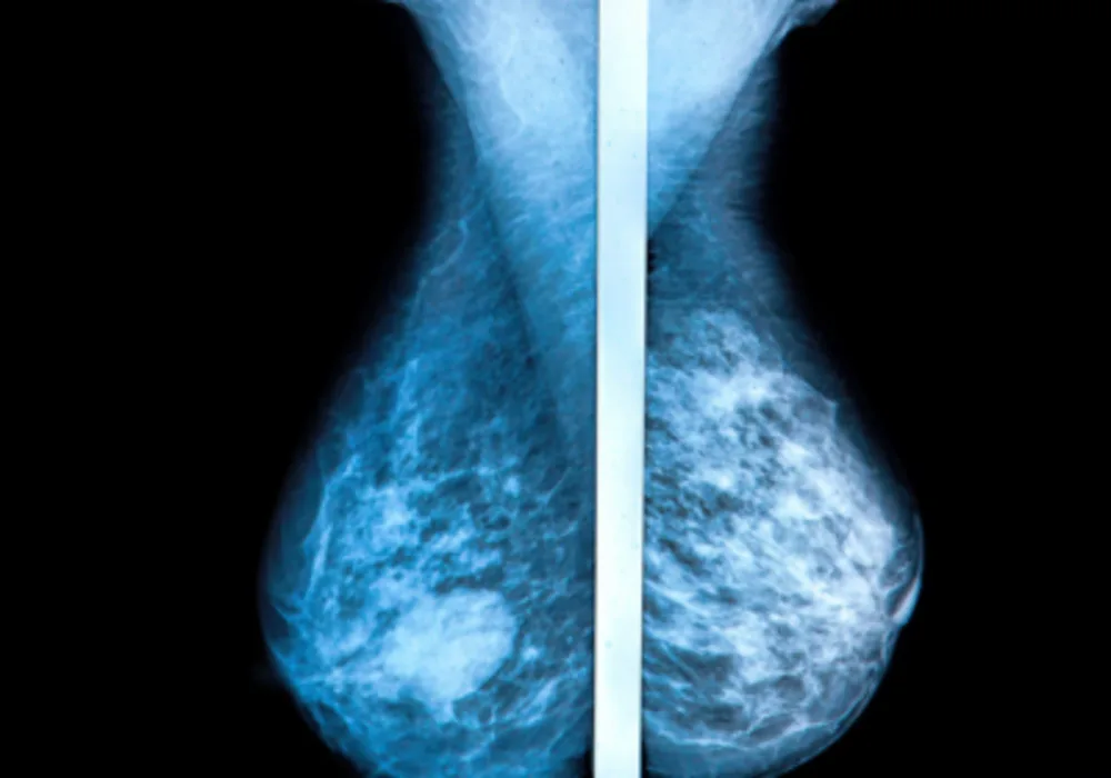 Digital Breast Tomosynthesis Plus Mammography Improves Early Diagnosis