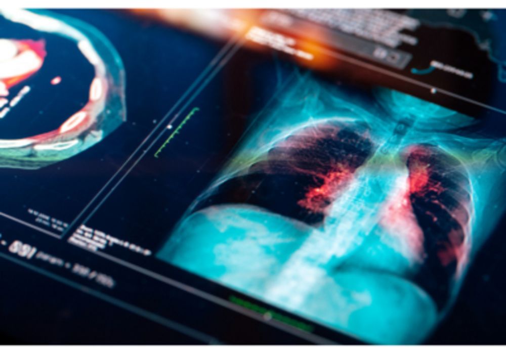 Clinical Decision Support Improve Pneumonia Outcomes