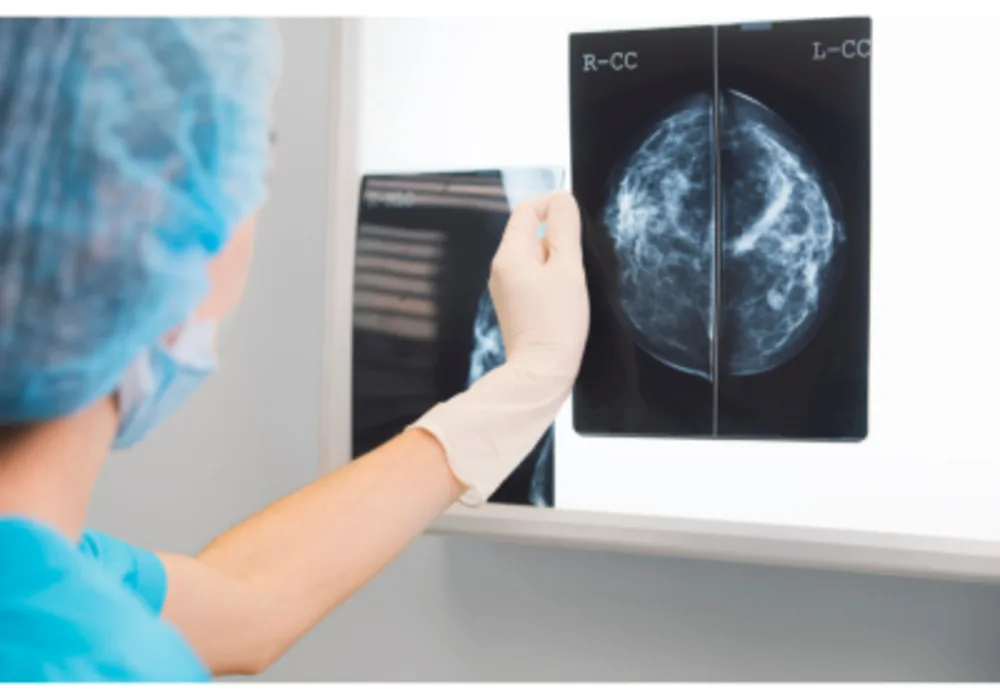 An AI Algorithm for Determining Breast Density on BI-RADS Scale