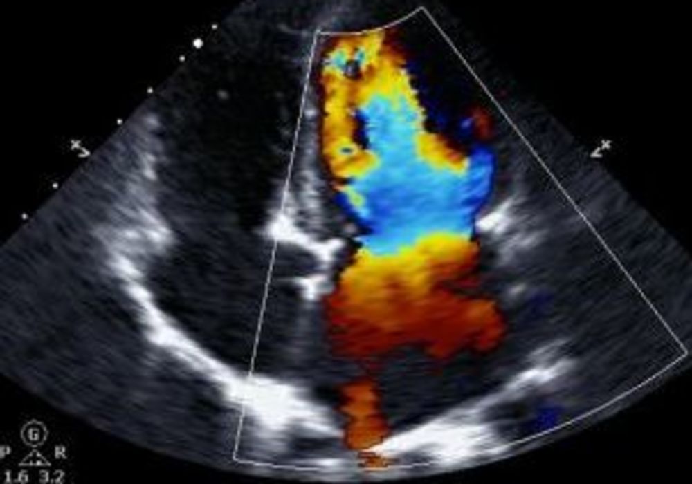 Heart Ultrasound Determines Dementia Risk