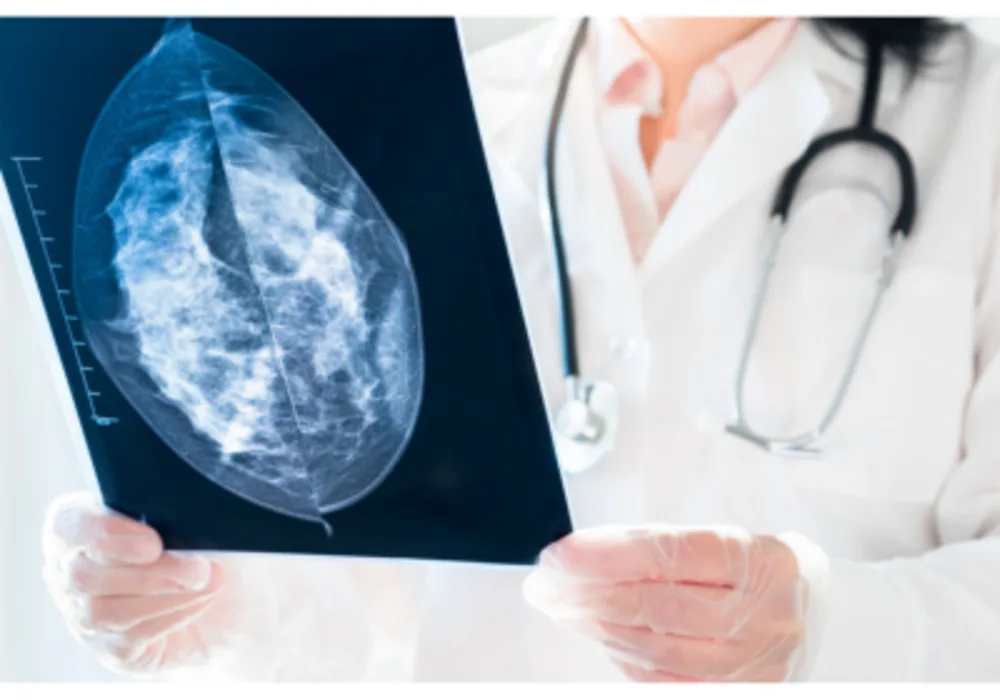 AI as Second Reader Performs Well in Breast Cancer Screening 
