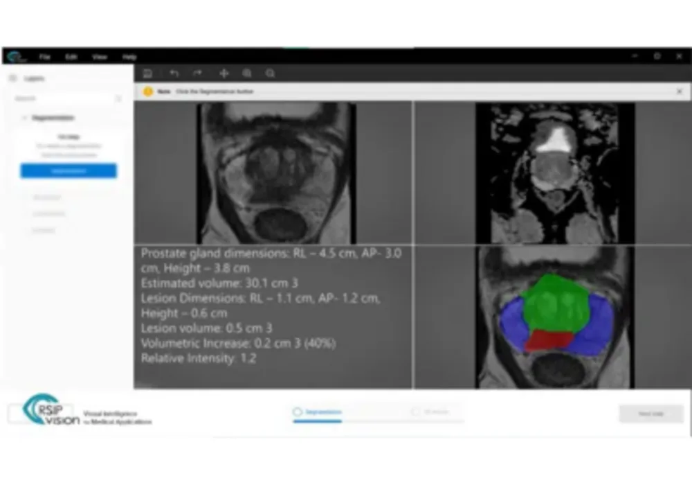 New AI Tool for Prostate MRI Analysis to Support PI-RADS Scoring