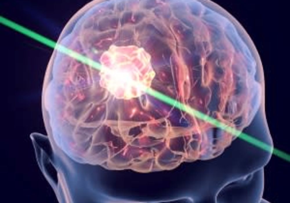 The NHS Announced Cutting-Edge Laser to Treat Epilepsy 