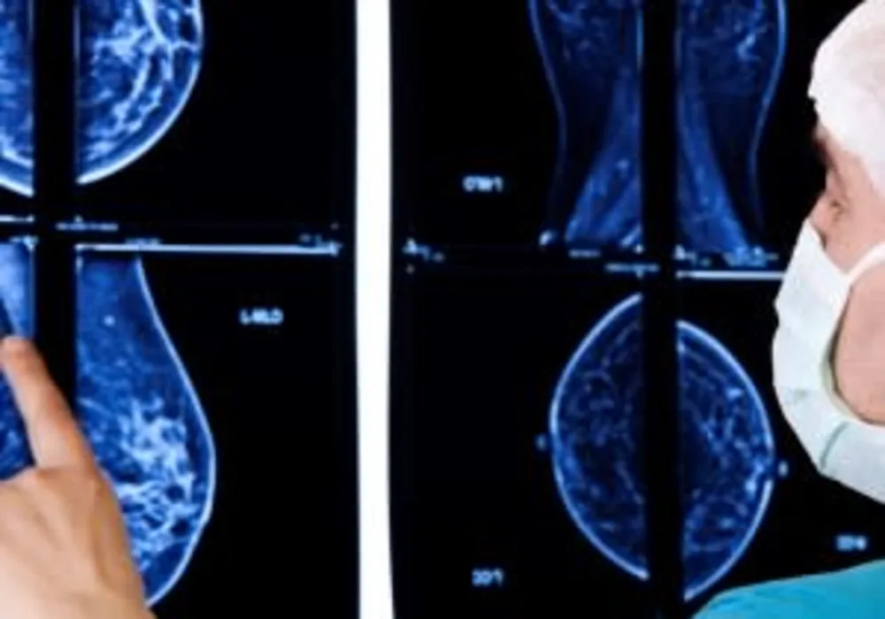 Study Finds Women with Benign Breast Disease Face Long-Term Risk of Breast Cancer