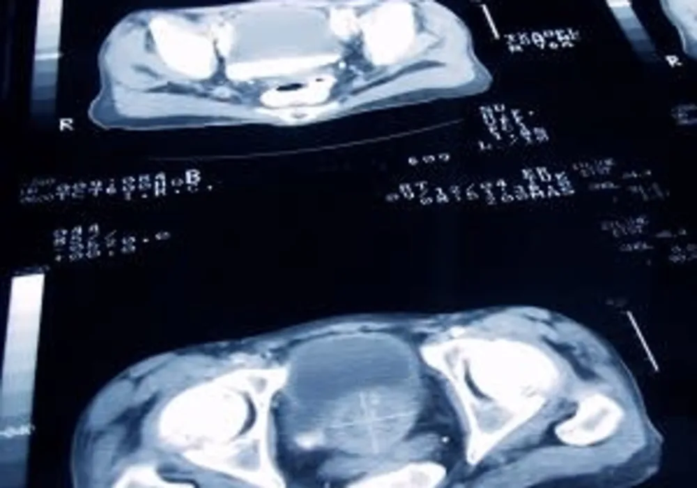 AI-Aided Software Reduces Prostate MRI Read Times