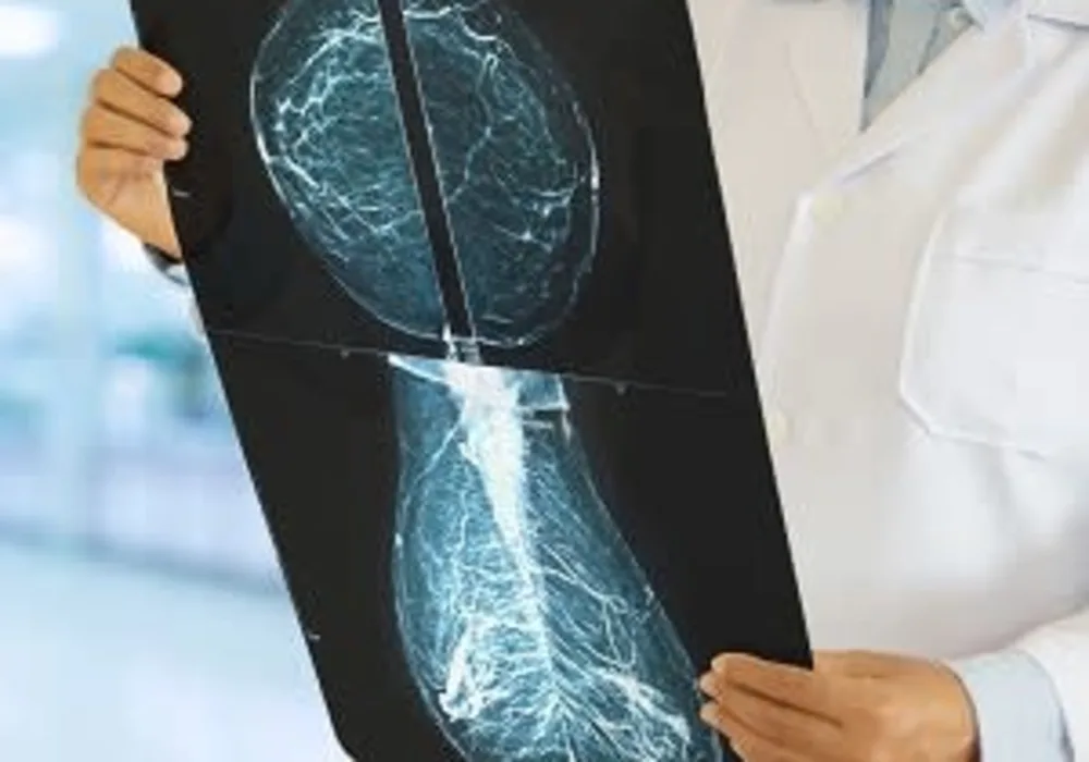 Changes in Breast Density Overtime Signals Breast Cancer Risk