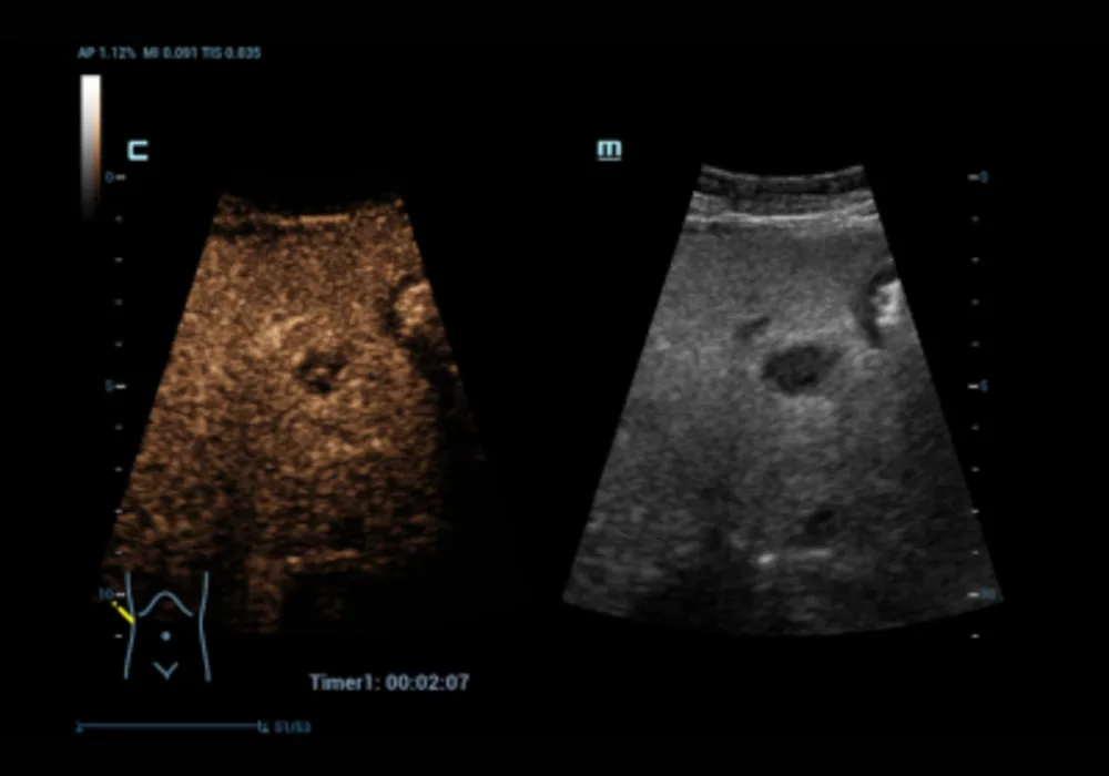 Expert Insights on HiFR-CEUS in Liver Diagnosis