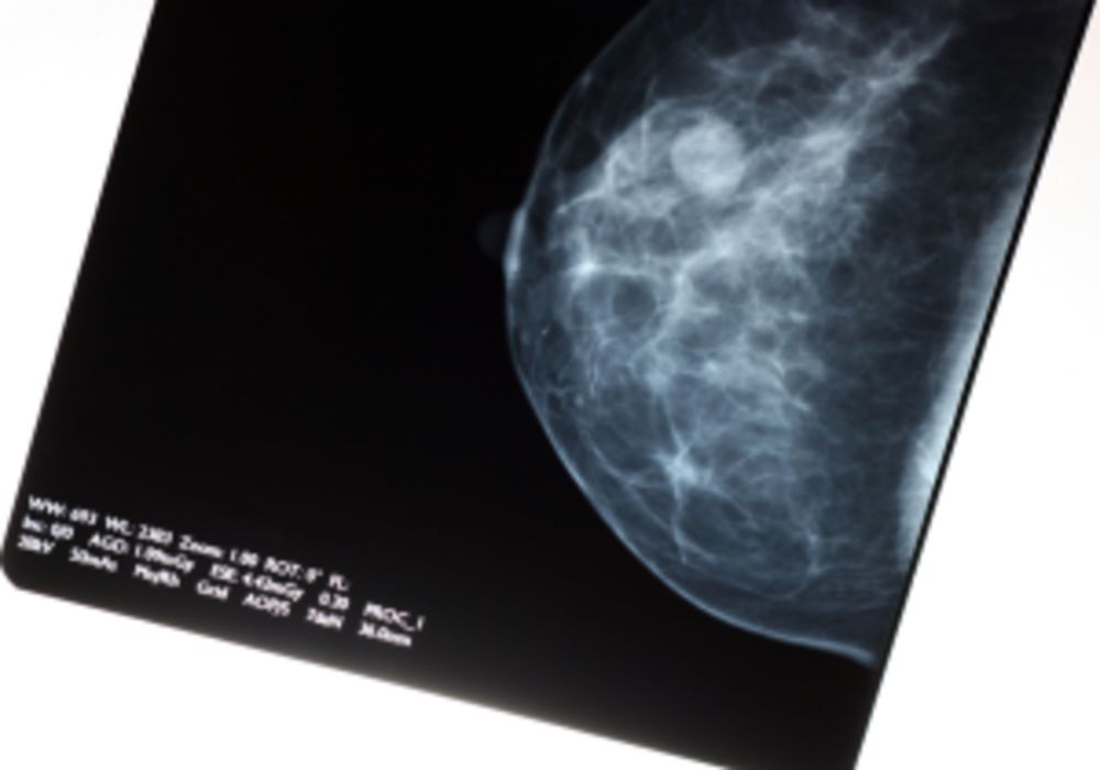 20% Increase in Breast Cancer Detection with AI-Supported Mammogram Screening