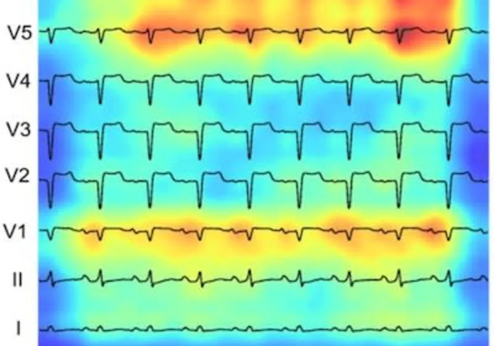 AI-Driven Model Redefines Right Heart Health Assessment