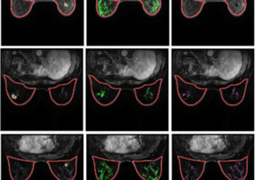 DCE-MRI Technique to Predict Breast Cancer Recurrence Risk