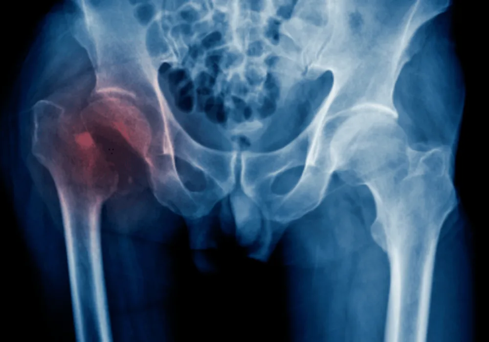 Deep Learning Model Predicts Subsequent Short-term Hip Fractures