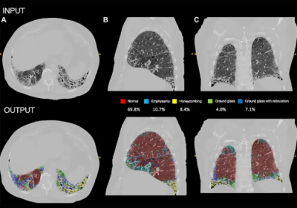 AI Improves Prognosis for Pulmonary Hypertension