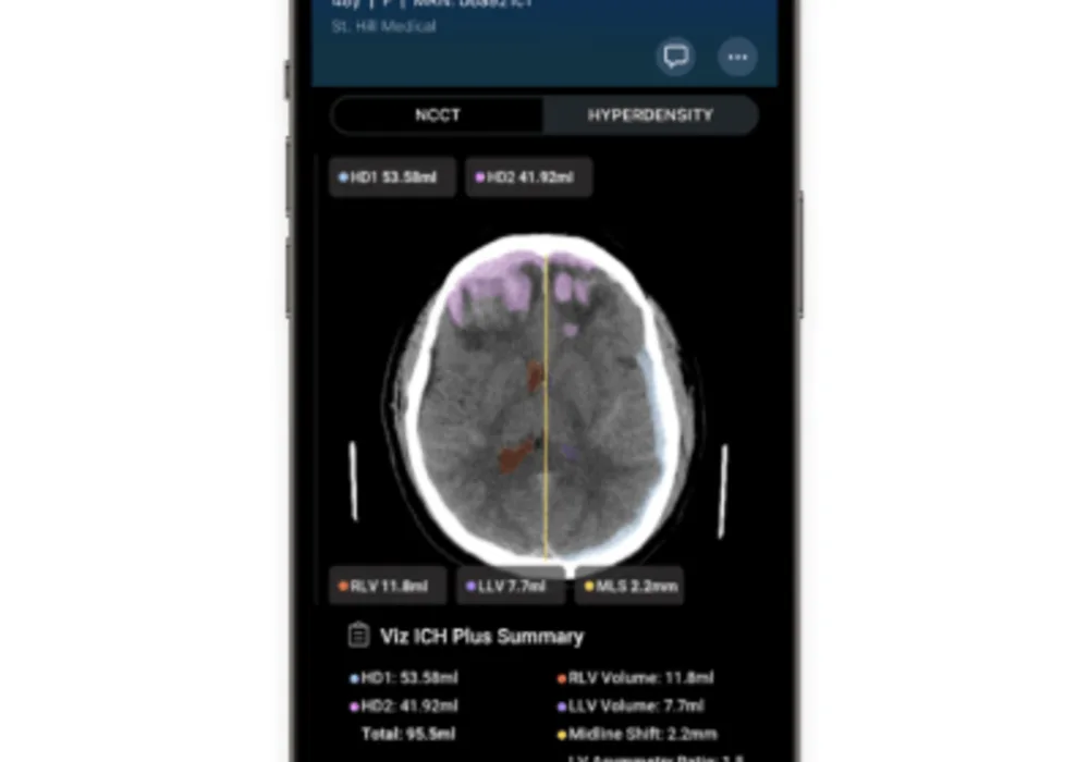 Viz.ai Gets FDA Clearance for AI Algorithm Detecting Brain Bleeds