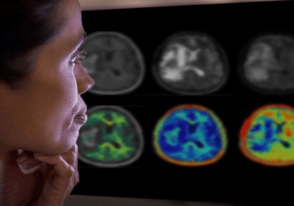 Philips &amp; Synthetic MR: Advancing Neurology Care with AI Brain Imaging at #ECR2024