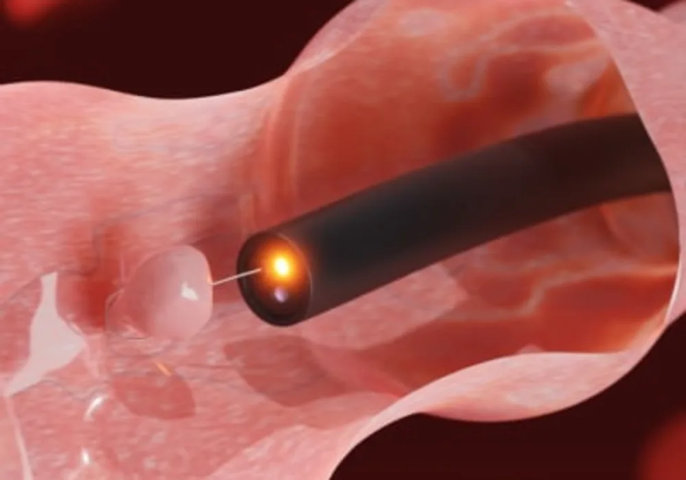 Ultra-Miniature SFDI System Shows Promise in Detecting Gastrointestinal Cancers