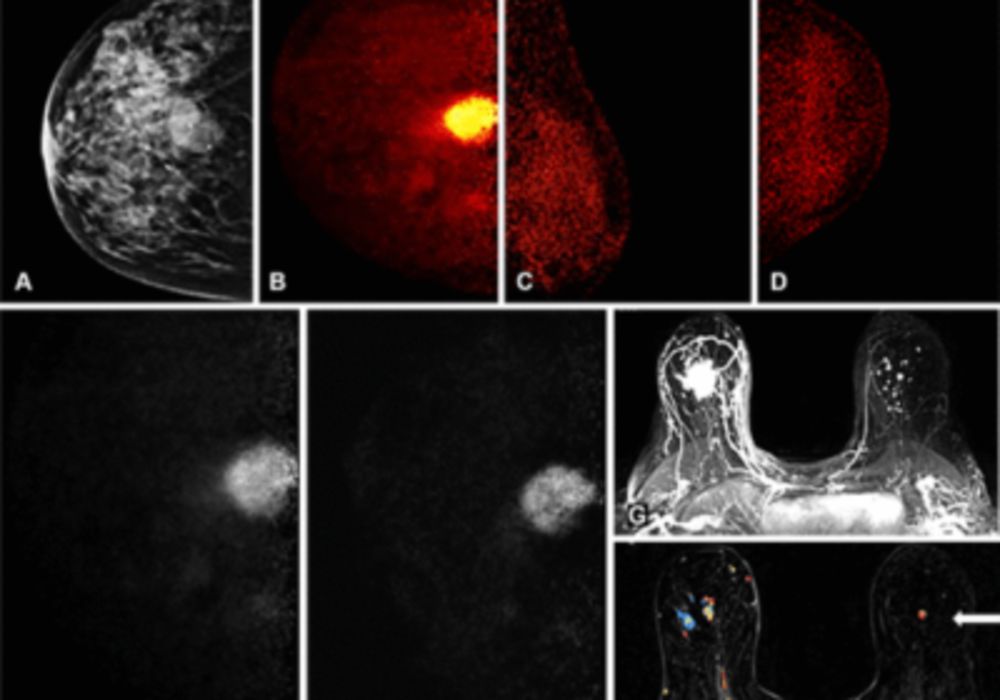 Breast Cancer: Low-Dose PEM Alongside MRI Could Improve Detection and Reduce Healthcare Costs.