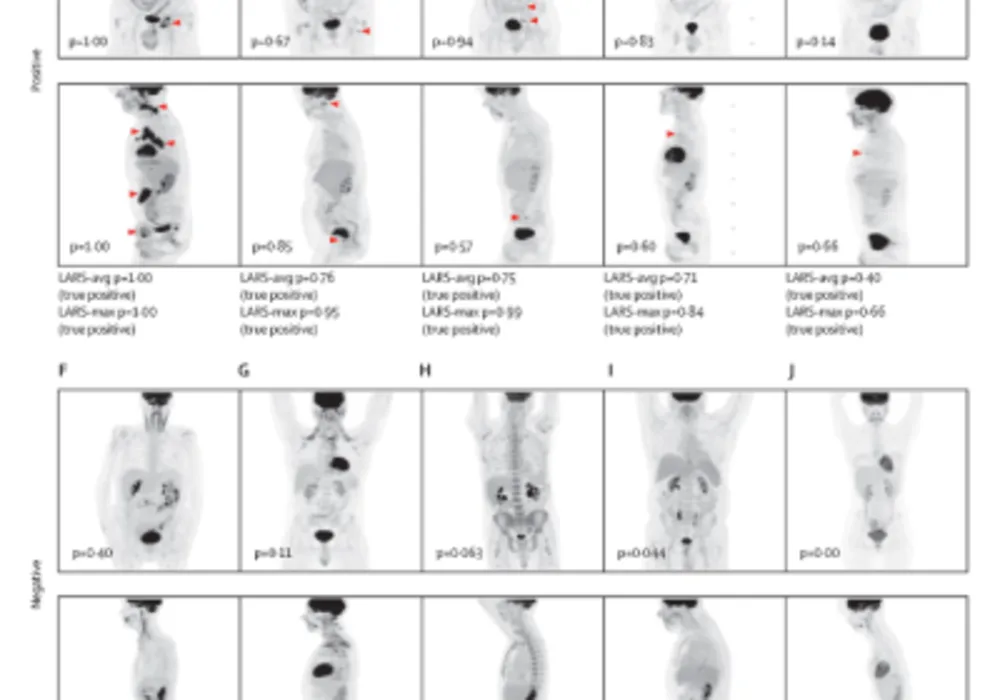 Deep Learning PET Imaging Model for Lymphoma Shows Clinical Potential