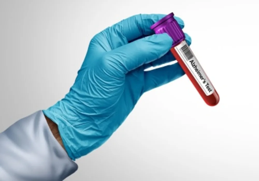 Revolutionising Alzheimer&#039;s Diagnosis with Light-Based Blood Test 