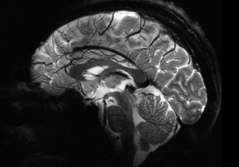 World&rsquo;s Most Powerful MRI Machine Offers Unprecedented Clarity in Brain Imaging