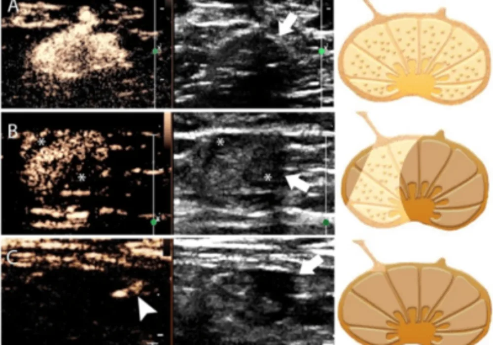 Nomogram Integrates CEUS &amp; Grayscale US to Predict Lymph Node Metastasis