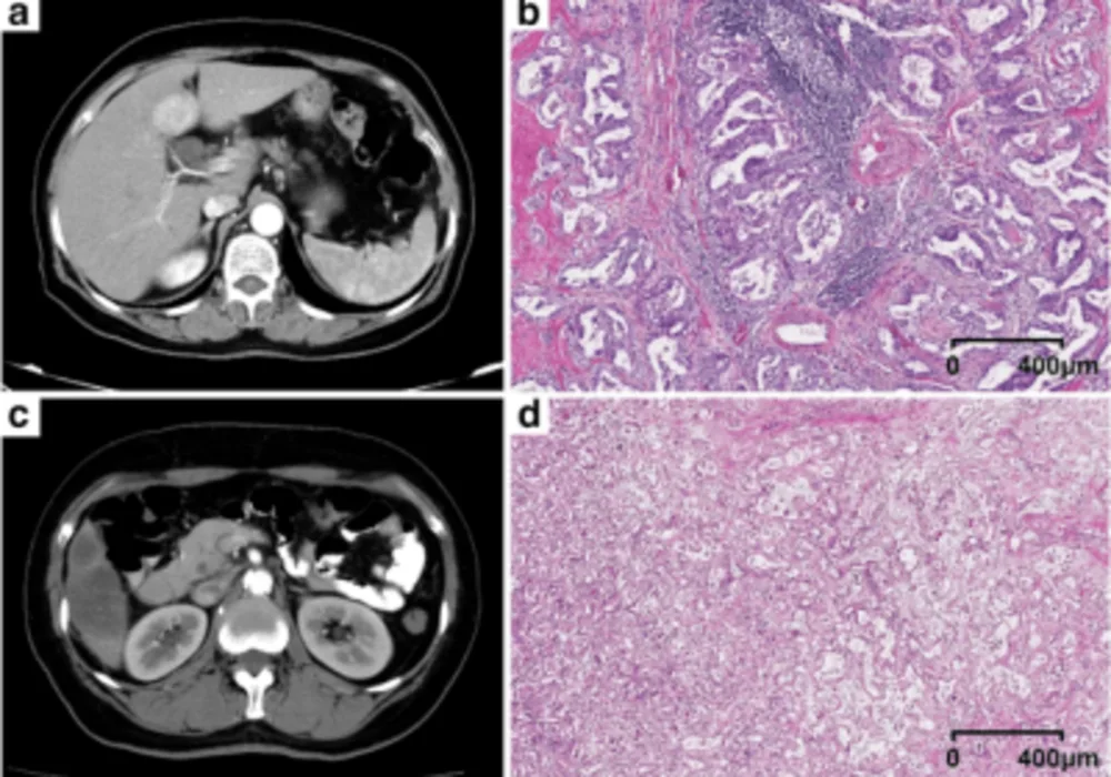 Prognostic Stratification for Liver Cancer Using CT Radiomics