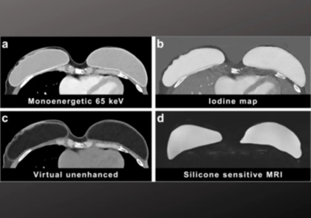 Assessing Silicone Breast Implants Ruptures with PCCT