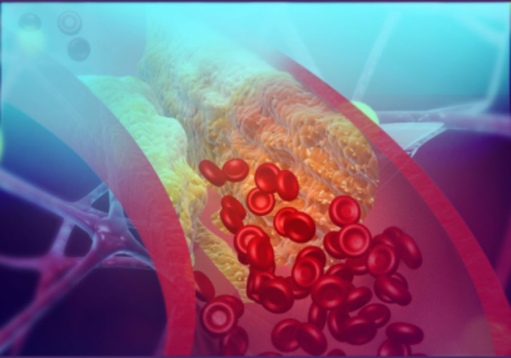 CT-FFR Analysis Lowers Invasive Procedures for Coronary Artery Disease Diagnosis