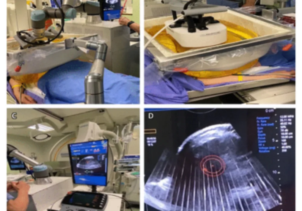 Advancements and Applications of Histotripsy in Tumour Tissue Ablation