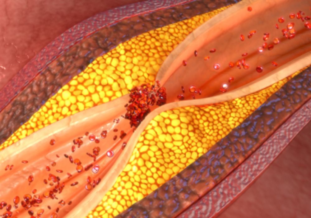 Prognostic Significance of CAD-RADS in Suspected Coronary Artery Disease