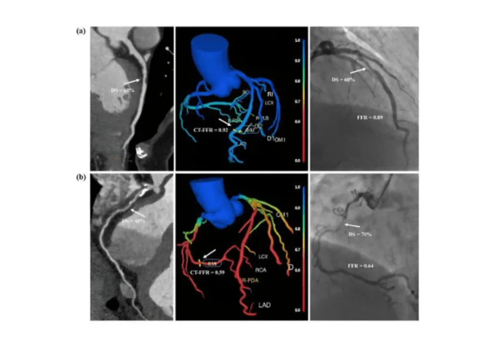 AI-Based Automated On-Site CT-FFR in Patients With CAD