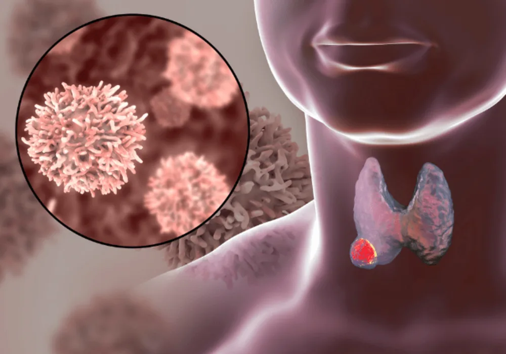 Enhancing Thyroid Nodule Characterisation: A CT-Based Radiomics Approach