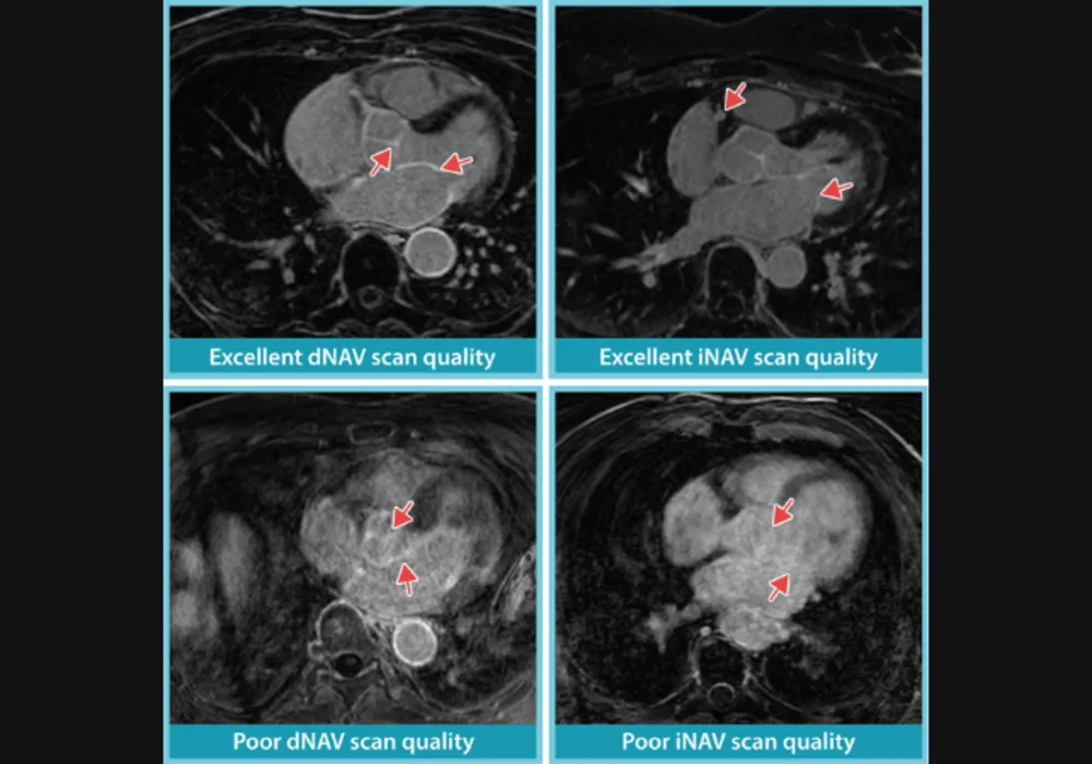 Performance of iNAV and dNAV Cardiac MRI Techniques for Atrial Fibrosis