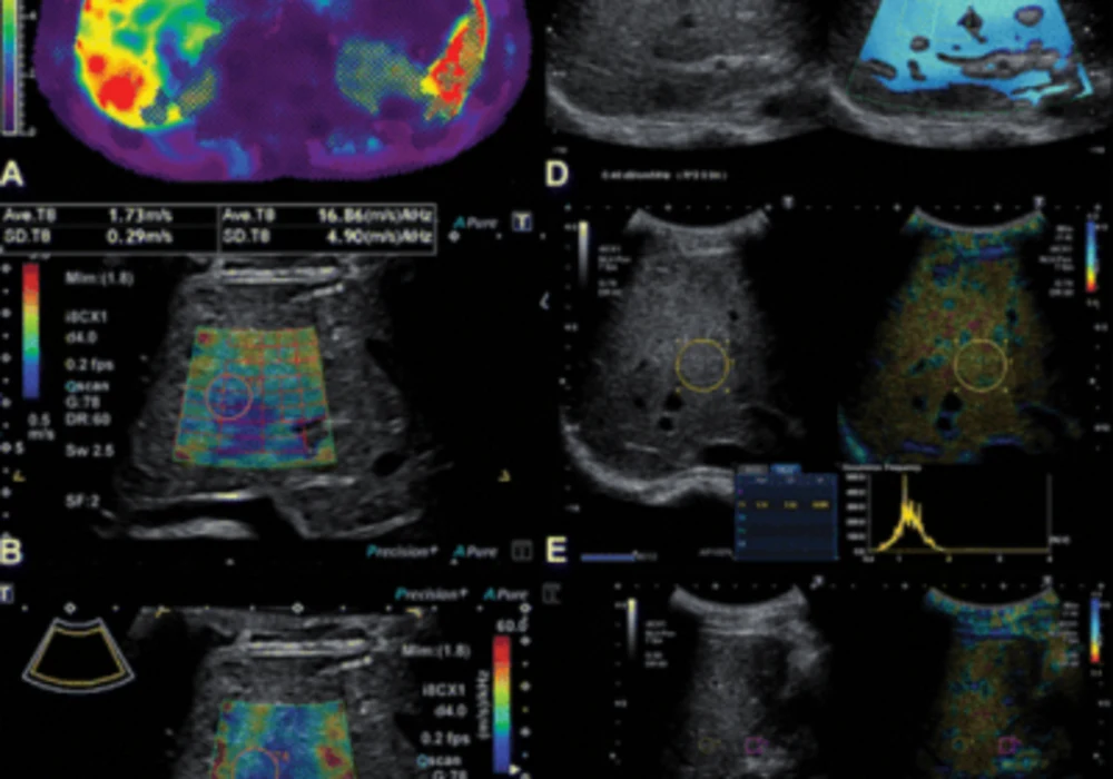 Assessing Liver Disease in Youth: A Comparative Study of Ultrasound and MRI Techniques