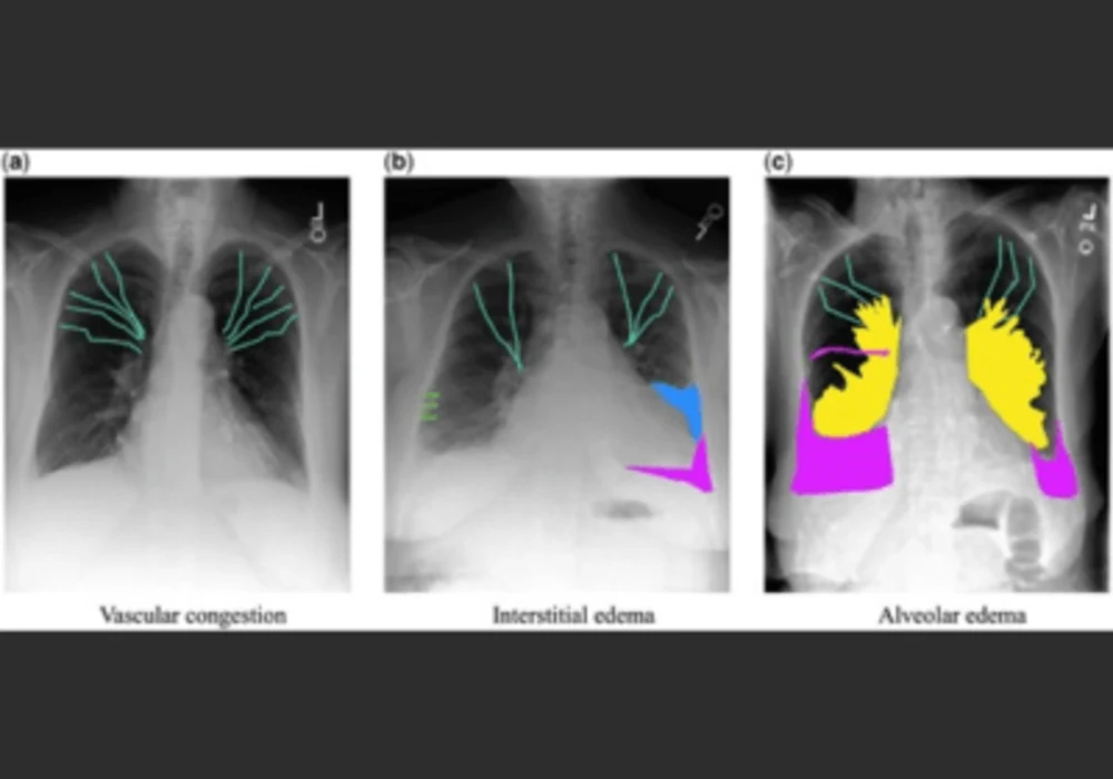 Automated Detection and Localization of Pulmonary Oedema Features in Chest X-Rays