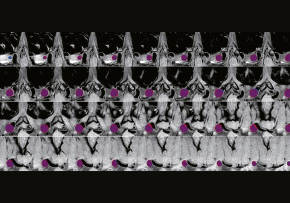 Pioneering Deep Learning in Intracranial Aneurysm Detection