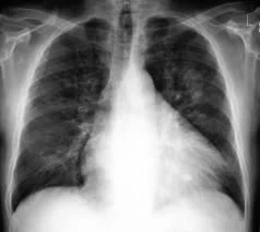 Lung_MRI.jpg