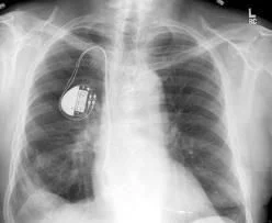 pacemaker.jpg