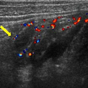 ultrasound appendicitis.jpg