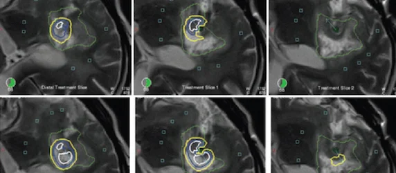 New MRI-Guided Laser Treatment for Brain Tumour