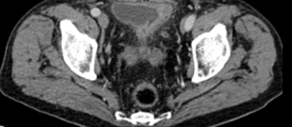 Bladder Cancer Imaging